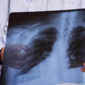 The role of reducing reactivity of adaptive processes in the body of the wounded  in the development of pneumonias
